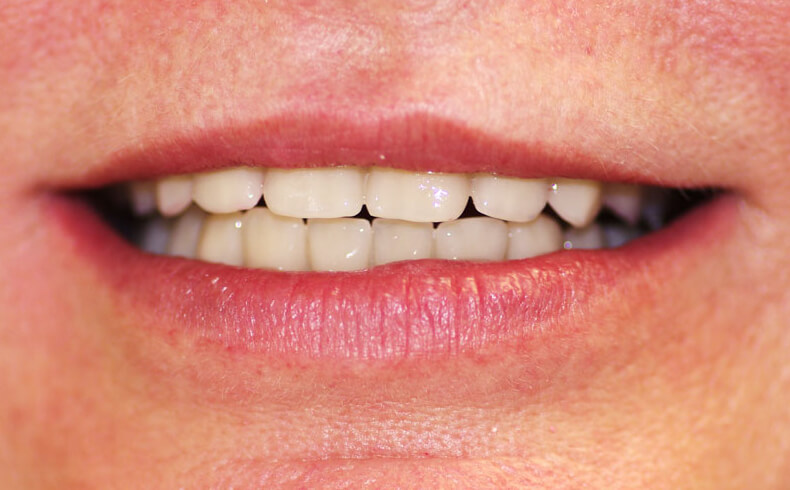 Dantų protezavimas ant implantų. Bedančiai žandikauliai