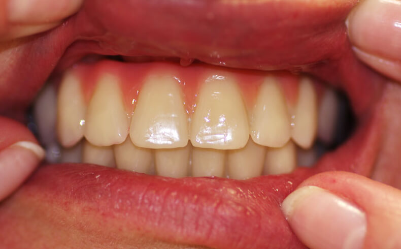 Dantų protezavimas ant implantų. Bedančiai žandikauliai
