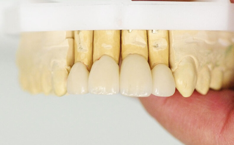 Estetinis dantų protezavimas keramikos laminatėmis