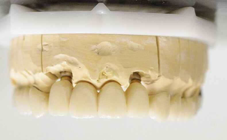 Dantų protezavimas ant implantų