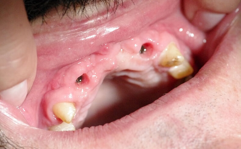 Dantų protezavimas ant implantų